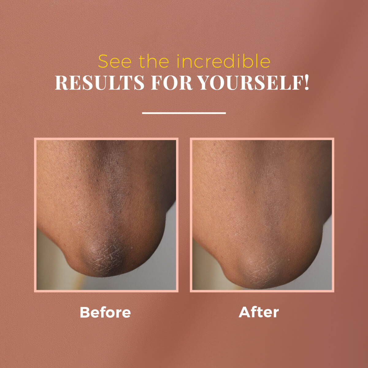 Anti-Pigmentation Kit - Nutmeg & Arjuna Bark for Uneven Skin Tone