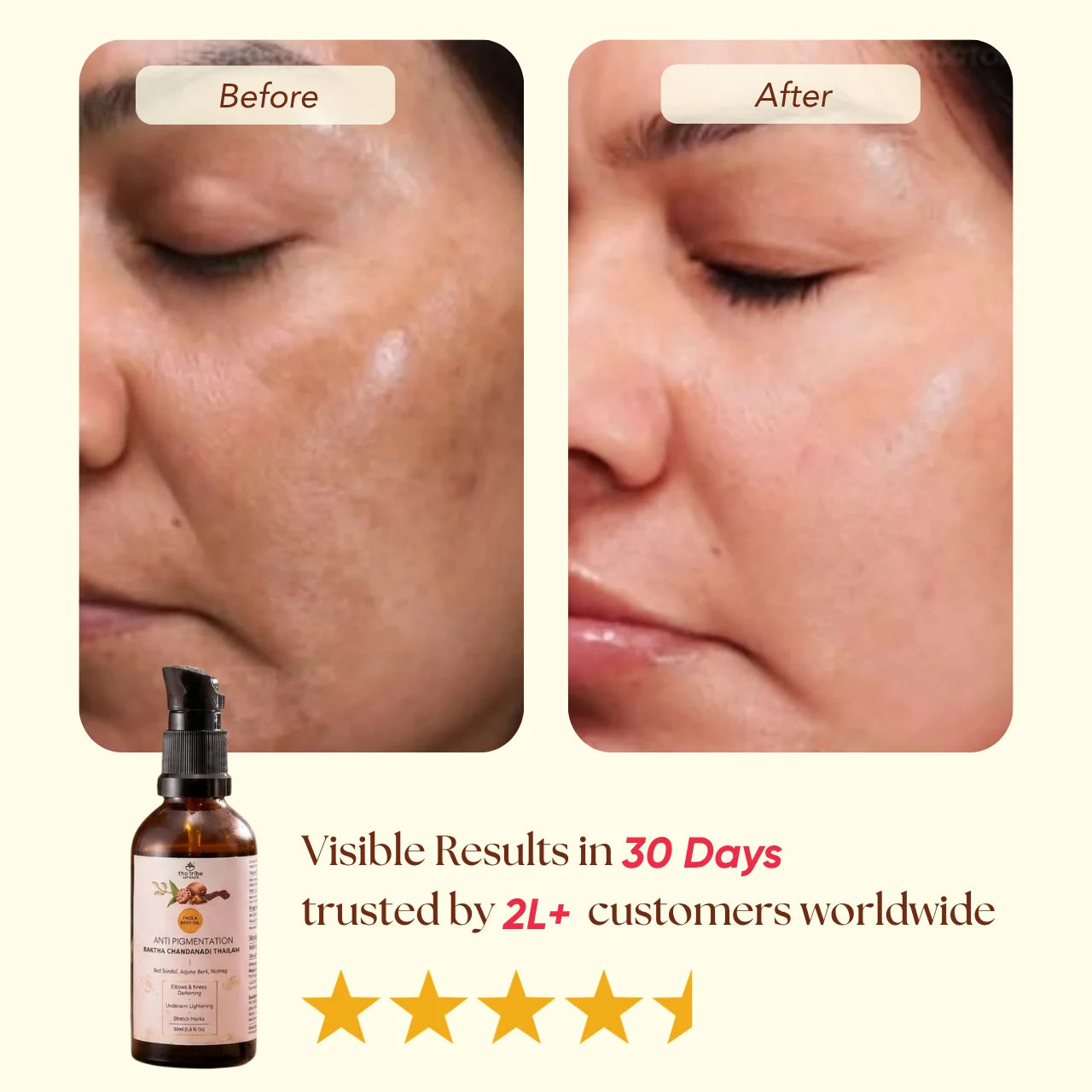 Anti-Pigmentation Raktha Chandanadi Thailam - Nutmeg & Arjuna Bark For Pigmentation & Tan Removal
